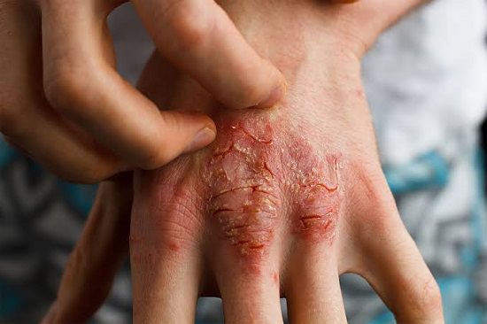 Skin Related Disease