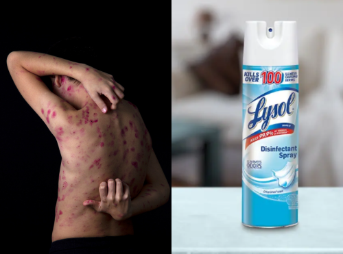 Does Lysol Kill Scabies1